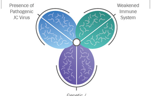 Care este conexiunea dintre Scleroza Multiplă și virusul JC?