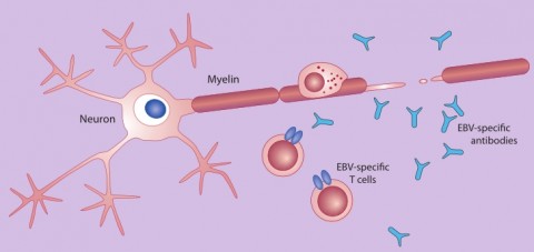 Celulele T în SM - progres în cercetare